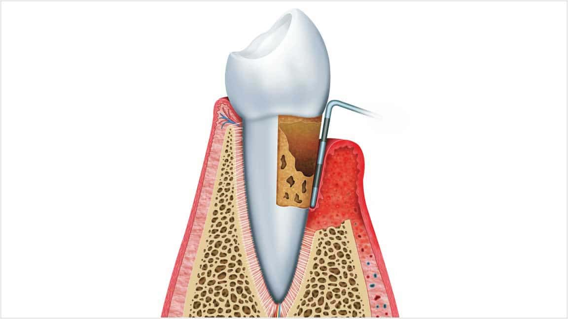 About Gum Disease Oak Park, IL
