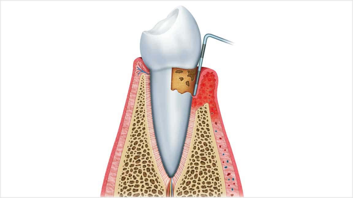 About Gum Disease Oak Park, IL