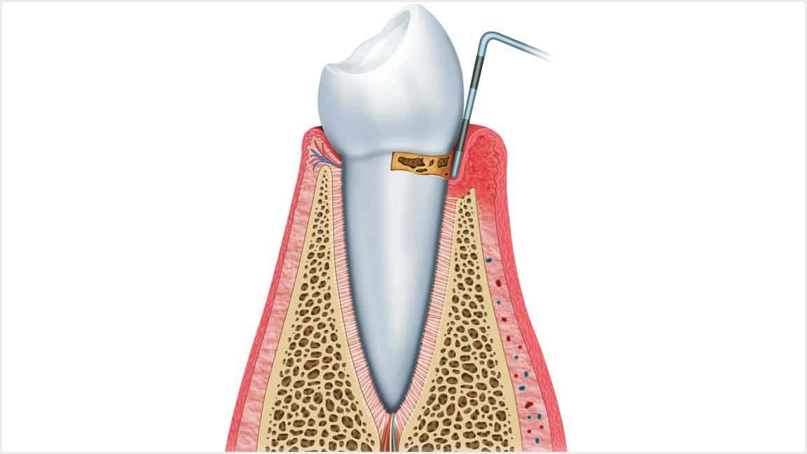 About Gum Disease Oak Park, IL